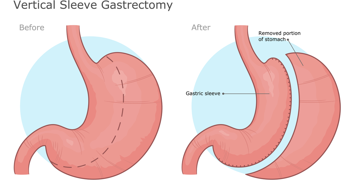 Gastric Sleeve