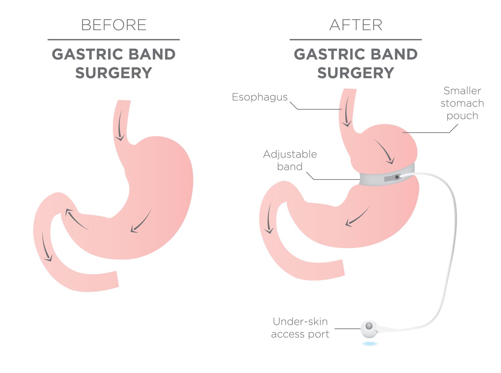 Lap Band Surgery